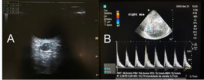 Ten Good Reasons to Practice Neuroultrasound in Critical Care Setting